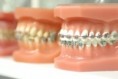 /album/orthodontics/orthodontis-2-jpg/